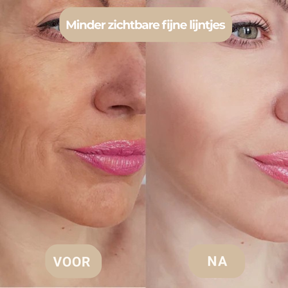 Microneedling huidtextuur verbeteren thuis – voor en na resultaat Micro-Infusion – ElleCera