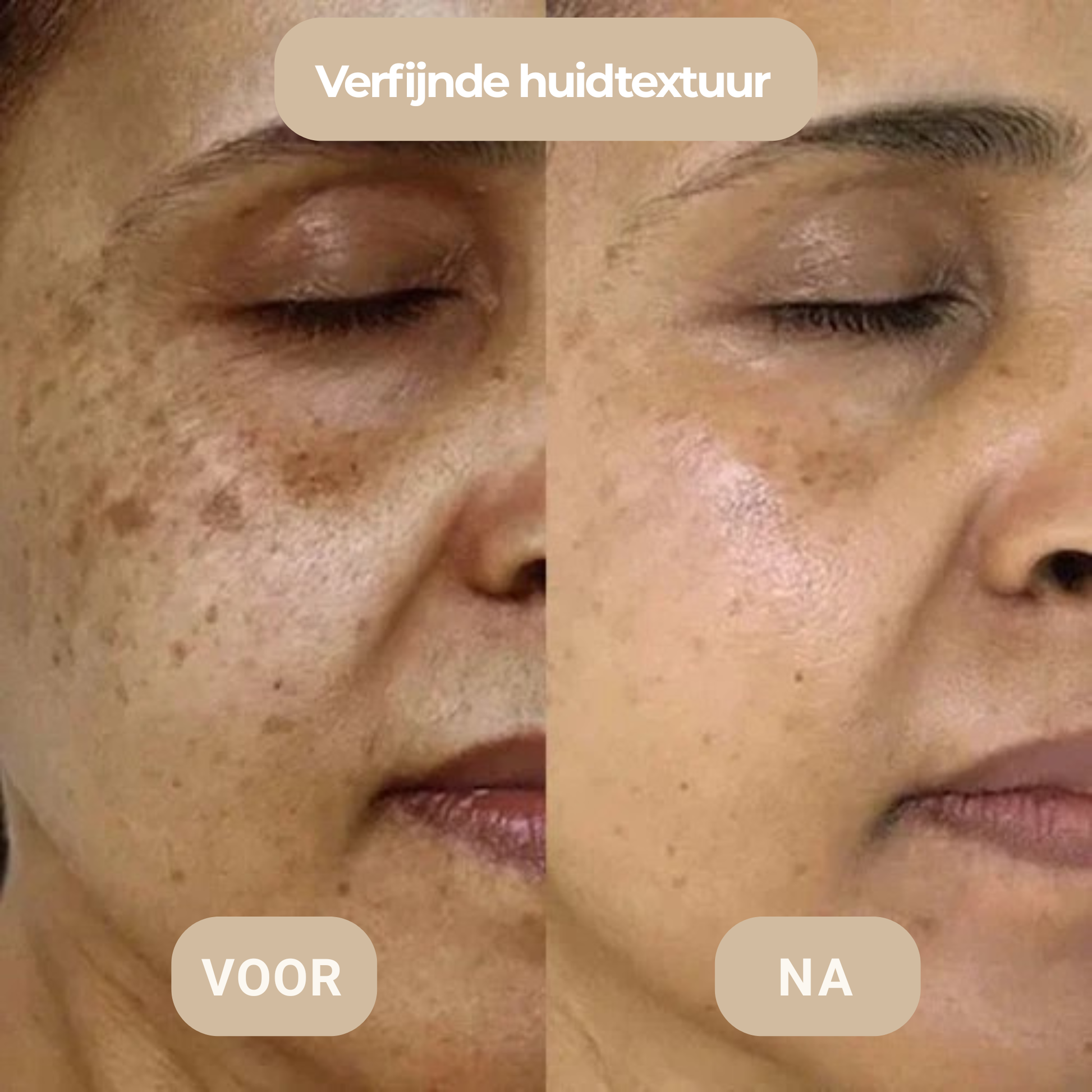 Microneedling voor en na – minder donkere vlekken en pigmentatie thuis – ElleCera