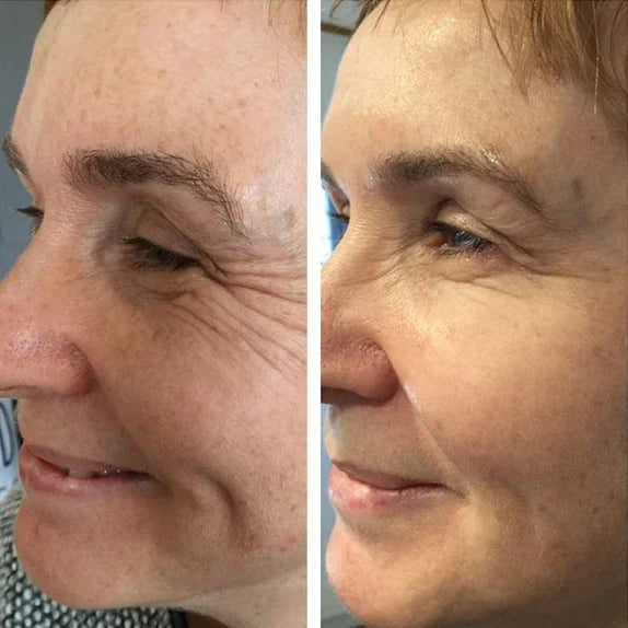SilkPeptide Ampoule voor en na – zichtbaar minder rimpels – ElleCera
